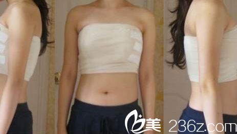 假體隆胸術后第二天恢復