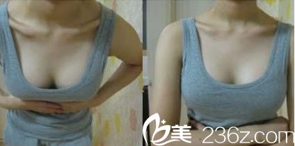 藍貝假體隆胸術后十天恢復