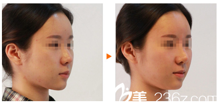李彤彤院長自體脂肪填充面部案例