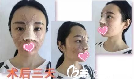 自體軟骨隆鼻第三天