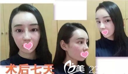 面部脂肪填充+自體軟骨隆鼻第7天