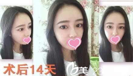 鼻整形+面部脂肪填充術(shù)后14天