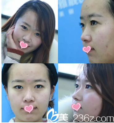 北京雅靚切開雙眼皮鼻綜合案例 北京雅靚切開雙眼皮鼻綜合案例