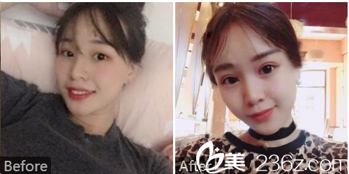 深圳美加美陳群院長(zhǎng)切開(kāi)雙眼皮案例圖