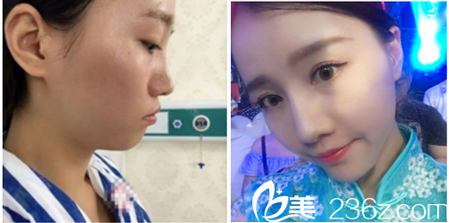 深圳美加美周?chē)?guó)偉做的鼻綜合隆鼻案例圖片