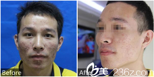 深圳美加美整形醫(yī)院李莉點(diǎn)陣激光祛痘案例