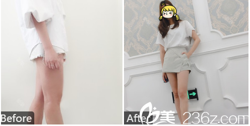 深圳美加美陳群醫(yī)生大腿吸脂案例圖
