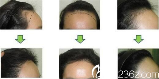 毛發(fā)移植真人前后對比