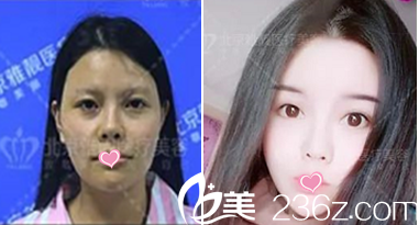 張春彥自體脂肪面部填充案例前后對比效果 張春彥自體脂肪面部填充案例前后對比效果