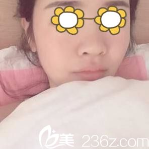 面部祛痘一周的效果