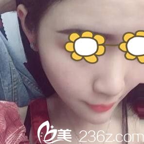 全臉祛痘半個月的效果