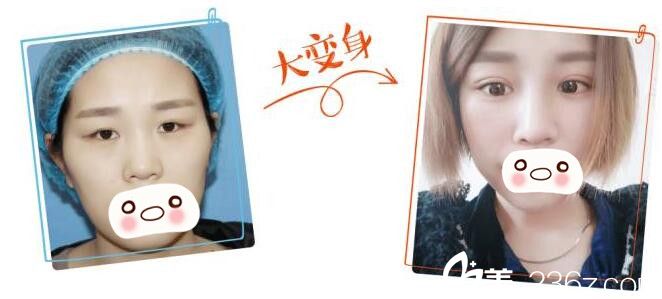 在南京美貝爾眼鼻整形術(shù)前術(shù)后蛻變 在南京美貝爾眼鼻整形術(shù)前術(shù)后蛻變