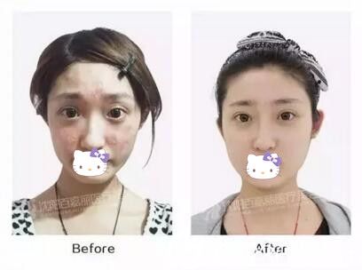 受損肌膚修復(fù)前后對比