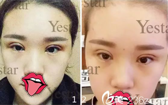 做完雙眼皮和祛皮祛脂術(shù)后3天 做完雙眼皮和祛皮祛脂術(shù)后3天