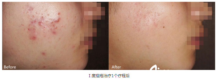 蘇州美貝爾激光祛痘案例