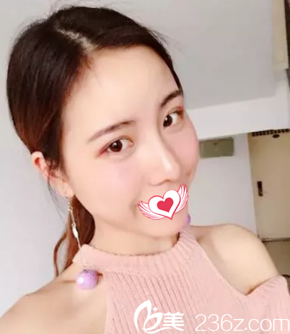 都說(shuō)季澤東院長(zhǎng)做鼻綜合效果自然 當(dāng)我到滄州靜港親身經(jīng)歷了硅膠隆鼻+耳軟骨墊鼻尖后覺(jué)得果然名不虛傳