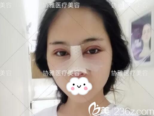 眼鼻手術(shù)后即刻術(shù)后效果