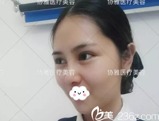 在協(xié)雅做眼鼻整形手術(shù)半個(gè)月效果