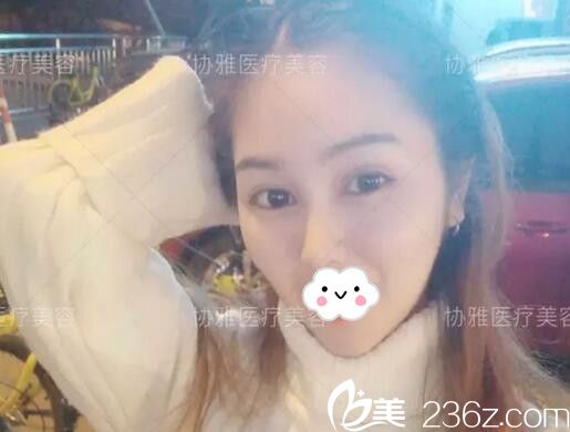 看我在長(zhǎng)沙協(xié)雅做了雙眼皮+鼻綜合術(shù)后不到1個(gè)月恢復(fù)效果完全超乎我的想象