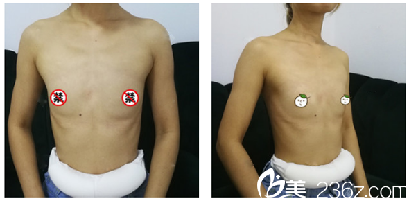 深圳南雅醫(yī)療美容整形醫(yī)院萬蕓術(shù)前照片1