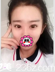 北京清木雙眼皮案例術(shù)后35天效果