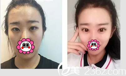 北京清木整形切開雙眼皮開眼角案例對比照