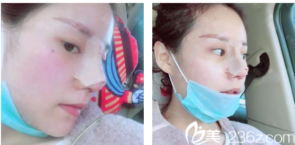 <!--<i data=20240703-sp></i>-->整形醫(yī)院羅志敏隆鼻子術后第五天 <!--<i data=20240703-sp></i>-->整形醫(yī)院羅志敏隆鼻子術后第五天