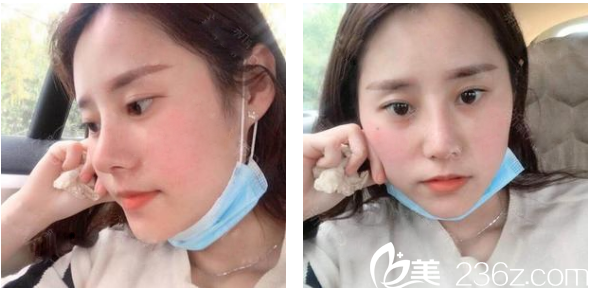 <!--<i data=20240703-sp></i>-->整形醫(yī)院羅志敏做的鼻綜合隆鼻術后半個月圖片 <!--<i data=20240703-sp></i>-->整形醫(yī)院羅志敏做的鼻綜合隆鼻術后半個月圖片