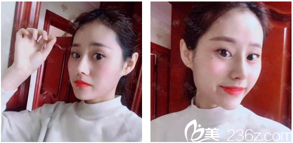 找<!--<i data=20240703-sp></i>-->整形醫(yī)院羅志敏做的鼻綜合隆鼻子術后一個月恢復情況 找<!--<i data=20240703-sp></i>-->整形醫(yī)院羅志敏做的鼻綜合隆鼻子術后一個月恢復情況