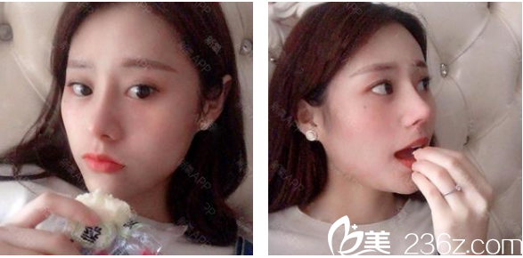 <!--<i data=20240703-sp></i>-->整形醫(yī)院羅志敏鼻綜合隆鼻子案例術后兩個月效果圖 <!--<i data=20240703-sp></i>-->整形醫(yī)院羅志敏鼻綜合隆鼻子案例術后兩個月效果圖