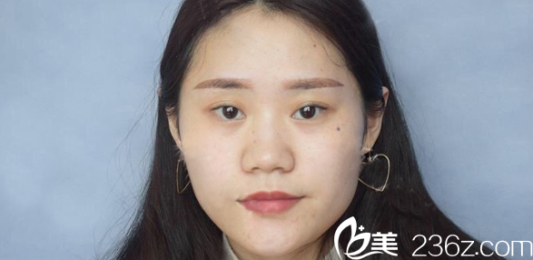 術前塌鼻子照片 術前塌鼻子照片