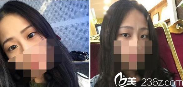 在維多利亞做雙眼皮手術(shù)前 在維多利亞做雙眼皮手術(shù)前