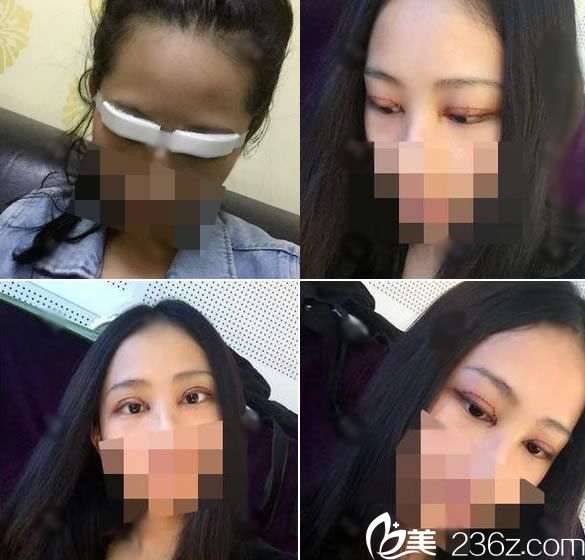 做完雙眼皮手術(shù)恢復(fù)3天效果 做完雙眼皮手術(shù)恢復(fù)3天效果