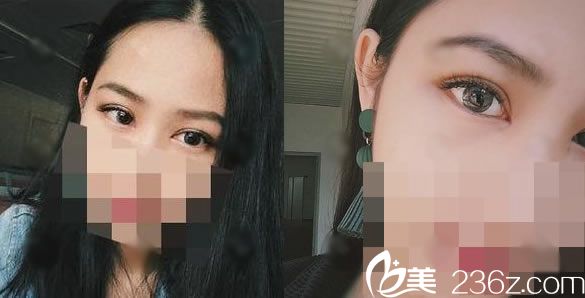 做完雙眼皮手術(shù)16天恢復(fù)效果 做完雙眼皮手術(shù)16天恢復(fù)效果