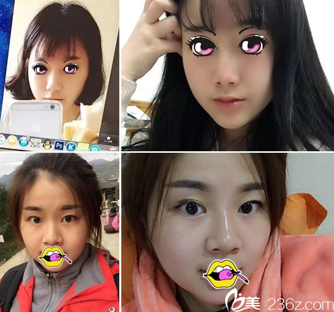 湖州尚麗整形雙眼皮和隆鼻<span style=