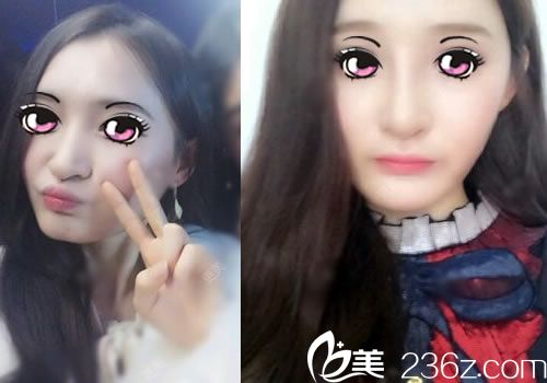 湖州尚麗李翔隆鼻案例效果圖