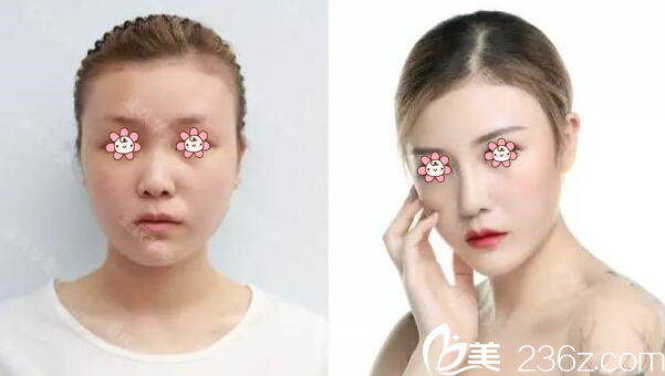 楊健達(dá)拉斯隆鼻案例