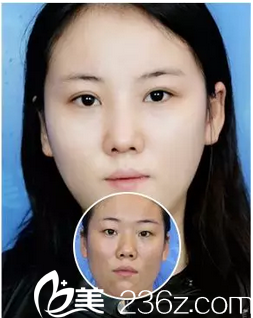 深圳非凡整形醫(yī)院丁峰雙眼皮案例對(duì)比圖