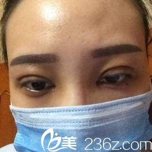 術(shù)后第三天 術(shù)后第三天