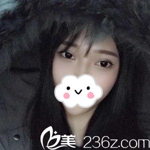 看萬醫(yī)生給我割的雙眼皮，一個月后自然無痕，超級自然