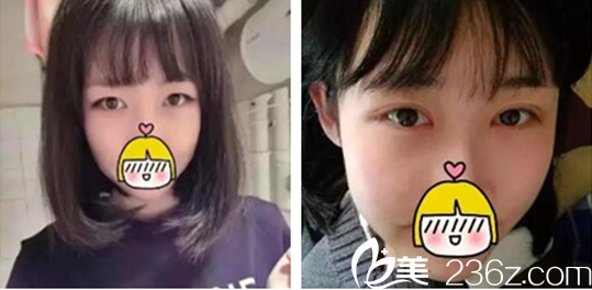 劉圓醫(yī)師美眼案例