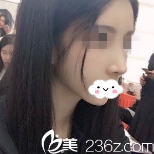 找趙福德院長取鼻假體+膨體隆鼻，分享我鼻綜合修復(fù)一個月恢復(fù)全過程