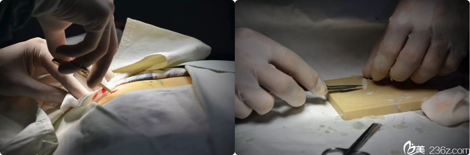 肋軟骨的取出和雕刻過(guò)程 肋軟骨的取出和雕刻過(guò)程