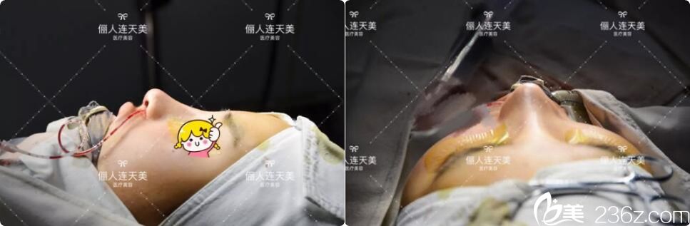 鼻綜合術(shù)后即刻效果展示 鼻綜合術(shù)后即刻效果展示