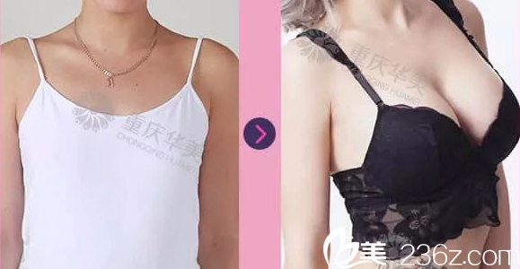 楊麗萍醫(yī)師豐胸案例