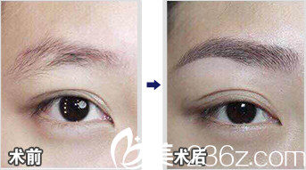 北京米蘭柏羽麗都馬建民眉毛種植效果