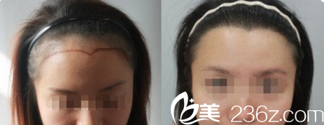 北京米蘭柏羽麗都美人尖種植效果