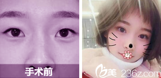 石海山醫(yī)師雙眼皮案例