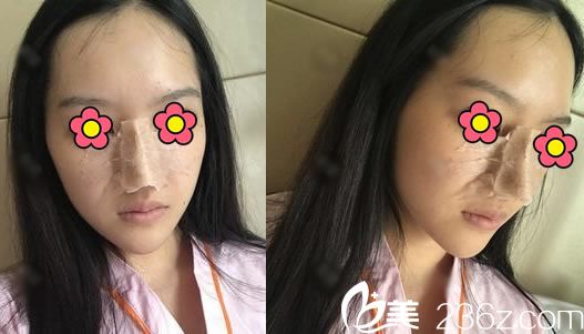 做完肋軟骨隆鼻手術(shù)當(dāng)天照片