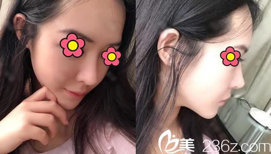 找杭州瑞麗做隆鼻20天后